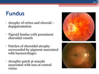 Fundus
• Atrophy of retina and choroid –
depigmentation
• Tigroid fundus with prominent
choroidal vessels
• Patches of choroidal atrophy
surrounded by pigment associated
with haemorrhages
• Atrophic patch at macula
associated with loss of central
vision
32
 