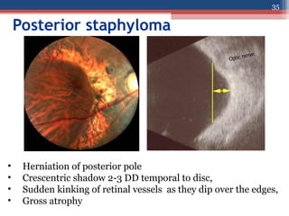 Posterior staphyloma
• Herniation of posterior pole
• Crescentric shadow 2-3 DD temporal to disc,
• Sudden kinking of retinal vessels as they dip over the edges,
• Gross atrophy
35
 