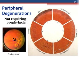 Peripheral
Degenerations
Not requiring
prophylaxis:
Paving stone
36
 