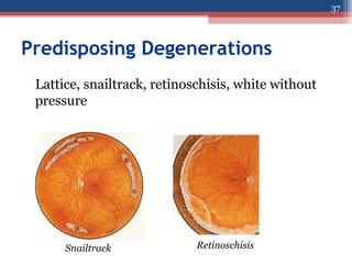 Predisposing Degenerations
Lattice, snailtrack, retinoschisis, white without
pressure
Snailtrack Retinoschisis
37
 