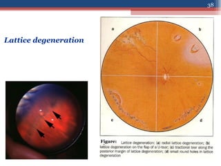 Lattice degeneration
Figure:
38
 