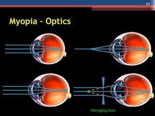 Myopia – Optics
Diverging lens
43
 