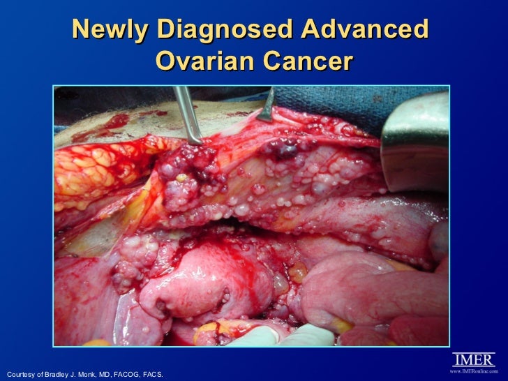 the features of ovarian cancer and its treatment A list of possible ovarian cancer symptoms such as vaginal bleeding, pain or pressure in the pelvic area, abdominal or back pain, bloating, difficulty eating, and a change in your bathroom habits. the features of ovarian cancer and its treatment A list of possible ovarian cancer symptoms such as vaginal bleeding, pain or pressure in the pelvic area, abdominal or back pain, bloating, difficulty eating, and a change in your bathroom habits.