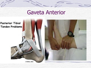 Gaveta Anterior
• Diagnosticar Ruptura
do lig. Talofibular
anterior
• Aumento da
mobilidade anterior
• HMA: correlação com
entorse em inversão
 