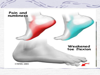 Tinel do Tarso
• Diagnosticar Síndrome do
Túnel do tarso
• Sinal de parestesia
• Síndrome do túnel do
tarso
 