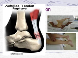 Thompson
• Diagnosticar Ruptura do
Tendão Calcâneo
• Não realiza flexão plantar ativa
• Síndrome da Pedrada / Lesão
total do tendão calcâneo
 