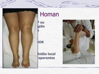 Homan
• Diagnosticar TVP ou
empastamento região
posterior da perna
• Sinal positivo : DOR
• Edema / Vermelhidão local
/ Veias colaterais aparentes
 