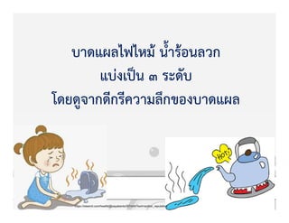 บาดแผลไฟไหมK น้ํารKอนลวก
แบZงเปpน 3 ระดับ
โดยดูจากดีกรีความลึกของบาดแผล
https://steemit.com/health/@sayabento/5t7mhh?sort=author_reputation
 