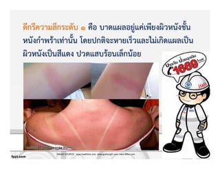 ดีกรีความลึกระดับ 1 คือ บาดแผลอยูZแคZเพียงผิวหนังชั้น
หนังกําพรKาเทZานั้น โดยปกติจะหายเร็วและไมZเกิดแผลเปpน
ผิวหนังเปpนสีแดง ปวดแสบรKอนเล็กนKอย
IMAGE SOURCE : www.healthline.com, www.gustrength.com, www.diffen.com
 