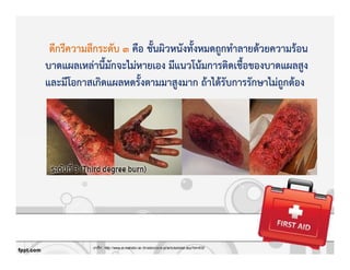 ดีกรีความลึกระดับ 3 คือ ชั้นผิวหนังทั้งหมดถูกทําลายดKวยความรKอน
บาดแผลเหลZานี้มักจะไมZหายเอง มีแนวโนKมการติดเชื้อของบาดแผลสูง
และมีโอกาสเกิดแผลหดรั้งตามมาสูงมาก ถKาไดKรับการรักษาไมZถูกตKอง
 