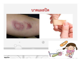 บาดแผลปtด
 