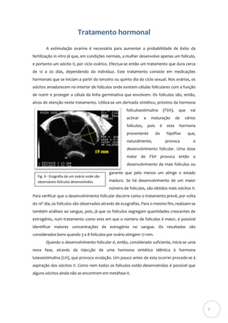 Tratamento hormonal
A estimulação ovarina é necessária para aumentar a probabilidade de êxito da
fertilização in vitro já que, em condições normais, a mulher desenvolve apenas um folículo,
e portanto um oócito II, por ciclo ovárico. Efectua-se então um tratamento que dura cerca
de 12 a 20 dias, dependendo do indivíduo. Este tratamento consiste em medicações
hormonais que se iniciam a partir do terceiro ou quinto dia do ciclo sexual. Nos ovários, os
oócitos amadurecem no interior de folículos onde existem células foliculares com a função
de nutrir e proteger a célula da linha germinativa que envolvem. Os folículos são, então,
alvos de atenção neste tratamento. Utiliza-se um derivado sintético, próximo da hormona
foliculoestimulina
activar
folículos,

a

(FSH),

maturação
pois

proveniente
naturalmente,

é
da

esta

que
de

vai

vários

hormona

hipófise

que,

provoca

o

desenvolvimento folicular. Uma dose
maior de FSH provoca então o
desenvolvimento de mais folículos ou
Fig. 4 - Ecografia de um ovário onde são
observáveis folículos desenvolvidos.

garante que pelo menos um atinge o estado
maduro. Se há desenvolvimento de um maior
número de folículos, são obtidos mais oócitos II.

Para verificar que o desenvolvimento folicular decorre como o tratamento prevê, por volta
do 10º dia, os folículos são observados através de ecografias. Para o mesmo fim, realizam-se
também análises ao sangue, pois, já que os folículos segregam quantidades crescentes de
estrogénio, num tratamento como este em que o número de folículos é maior, é possível
identificar maiores concentrações de estrogénio no sangue. Os resultados são
considerados bons quando 3 a 8 folículos por ovário atingem 17 mm.
Quando o desenvolvimento folicular é, então, considerado suficiente, inicia-se uma
nova fase, através da injecção de uma hormona sintética idêntica à hormona
luteoestimulina (LH), que provoca ovulação. Um pouco antes de esta ocorrer procede-se à
aspiração dos oócitos II. Como nem todos os folículos estão desenvolvidos é possível que
alguns oócitos ainda não se encontrem em metáfase II.

7

 