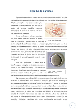 Recolha de Gâmetas
O processo de recolha dos oócitos é realizado sob o efeito de anestesia local, de
modo a ser o mais indolor possível para a paciente. Durante esta recolha, designada punção
folicular, uma agulha é passada através da vagina
para retirar o conteúdo folicular com uma sucção
suave,

sob

controlo

ecográfico

(ecografia

transvaginal). O processo é repetido para cada
folículo em ambos os ovários.
Com o auxílio de um estereomicroscópio
sob fluxo laminar (onde flui ar estéril de dentro
para fora, evitando a contaminação do material), o

Fig. 6 - Punção Folicular

conteúdo líquido destes folículos obtidos no centro cirúrgico, é transferido para uma placa
de meio de cultura e examinado à procura do oócito. Todo o procedimento é realizado de
forma a que o oócito não sofra variações importantes de temperatura, em ambiente
extremamente limpo, com uma série de cuidados em
relação à pureza do ar, e com controlo também da
luminosidade do laboratório, pois são sensíveis a estas
variações
Uma vez

identificado o oócito este é

transferido para outra placa contendo apenas meio de
cultura, e será classificado quanto á sua maturidade.
Podem ser classificados como imaturos ou maduros,
encontrando-se em metáfase II. Apenas os oócitos em

Fig. 7 - Oócito II maturo e
2º Glóbulo polar

metáfase II apresentam estado de maturação suficiente para serem fertilizados.
O processo de maturação oocitária consiste numa complexa sequência de eventos
nucleares e citoplasmáticos. Este processo é composto por inúmeras modificações
estruturais e moleculares no citoplasma (maturação citoplasmática), em que há síntese de
componentes citoplasmáticos, e que culminam com a configuração cromossómica em
metáfase II (maturação nuclear). O meio de cultura deverá conter os nutrientes necessários
para o metabolismo do oócito, que lhe serão proporcionados na forma de soro, uma
solução de unidades monoméricas de todos os nutrientes. Além das substâncias
adicionadas ao meio na solução de soro, os oócitos em cultivo também são afectados por
condições fisiológicas específicas, tais como: osmolaridade, composição iónica,

9

 