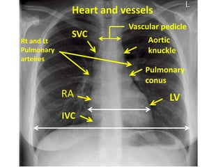 LV
Pulmonary
conus
Aortic
knuckle
RA
Rt and Lt
Pulmonary
arteires
SVC
IVC
Heart and vessels
Vascular pedicle
 