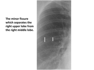 The minor fissure
which separates the
right upper lobe from
the right middle lobe.
 