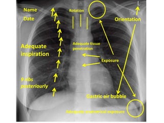 Name
Date Orientation
Adequate
inspiration
9 ribs
posteriourly
Exposure
Adequate tissue
penetration
Adequate anatomical exposure
Gastric air bubble
Rotation
 