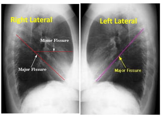 Left Lateral
Right Lateral
 