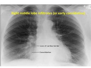 Right middle lobe infiltrates (or early consildation)
 