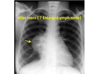 Hilar mass ( ? Enlarged ymph node)
 