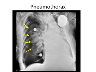 Pneumothorax
 