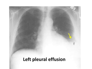 Left pleural effusion
 