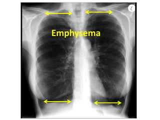 Emphysema
 