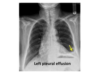 Left pleural effusion
 