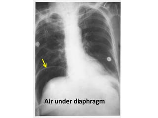 Air under diaphragm
 