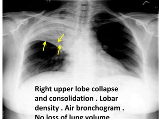 Right upper lobe collapse
and consolidation . Lobar
density . Air bronchogram .
 