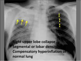 RUL infiltration with air bronchogram +
atelectasis
Right upper lobe collapse .
Segmental or lobar density
Compensatory hyperinflation of
normal lung
 