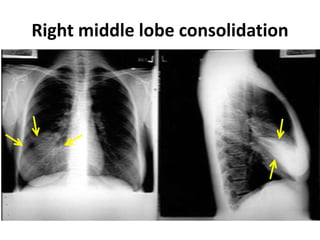 Right middle lobe consolidation
 