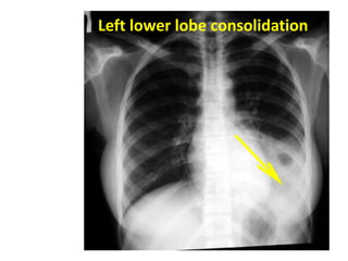 Left lower lobe consolidation
 