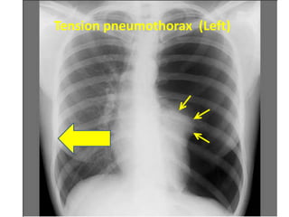 Tension pneumothorax
Tension pneumothorax (Left)
 
