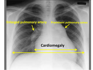 Pulmonary hypertension
Prominent pulmonary conus
Enlarged pulmonary artery
Cardiomegaly
 
