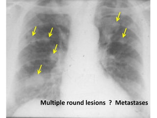 metastasis
Multiple round lesions ? Metastases
 