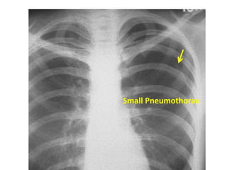 pneumothorax
Small Pneumothorax
 