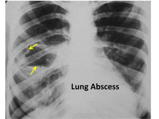 Infected hydatid cyst
Lung Abscess
 
