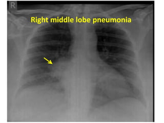 Figure 7: Right middle lobe pneumonia
Right middle lobe pneumonia
 