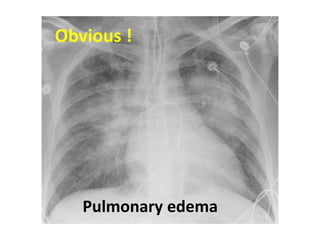 Obvious !
Pulmonary edema
 