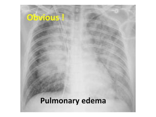 Obvious !
Pulmonary edema
 