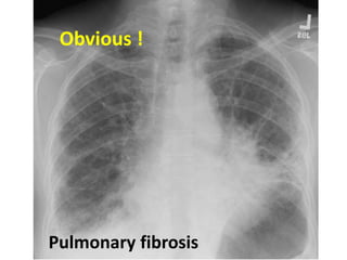 Pulmonary fibrosis
Obvious !
 