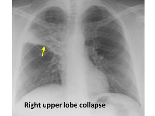 Right upper lobe collapse
 