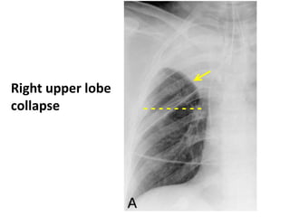 - - - - - - - -
Right upper lobe
collapse
 