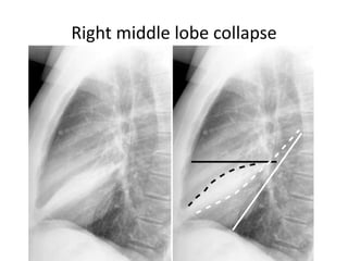 Right middle lobe collapse
 