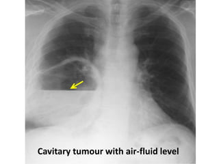 Cavitary tumour with air-fluid level
 