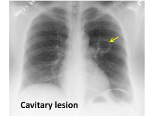 Cavitary lesion
 
