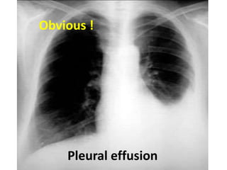 Pleural effusion
Obvious !
 