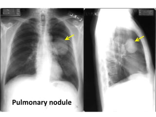 Pulmonary nodule
 