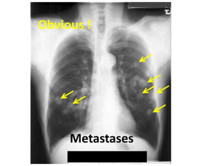 Obvious !
Metastases
 