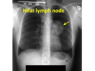 Hilar lymph node
 